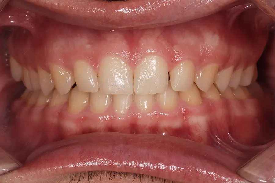 Caso Clínico de Carillas Dentales