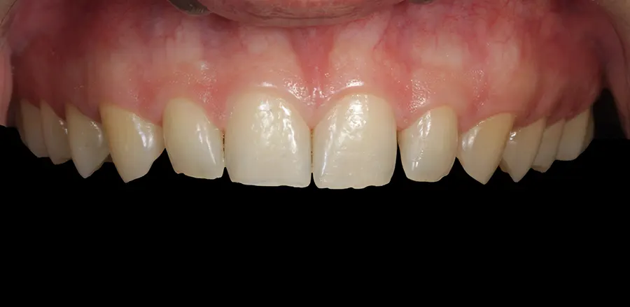 Caso Clínico de Carillas Dentales