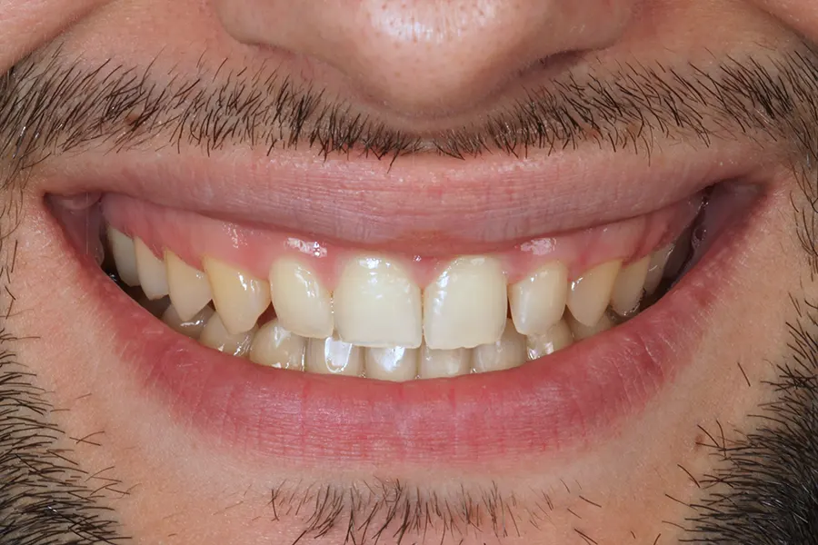 Caso Clínico de Carillas Dentales