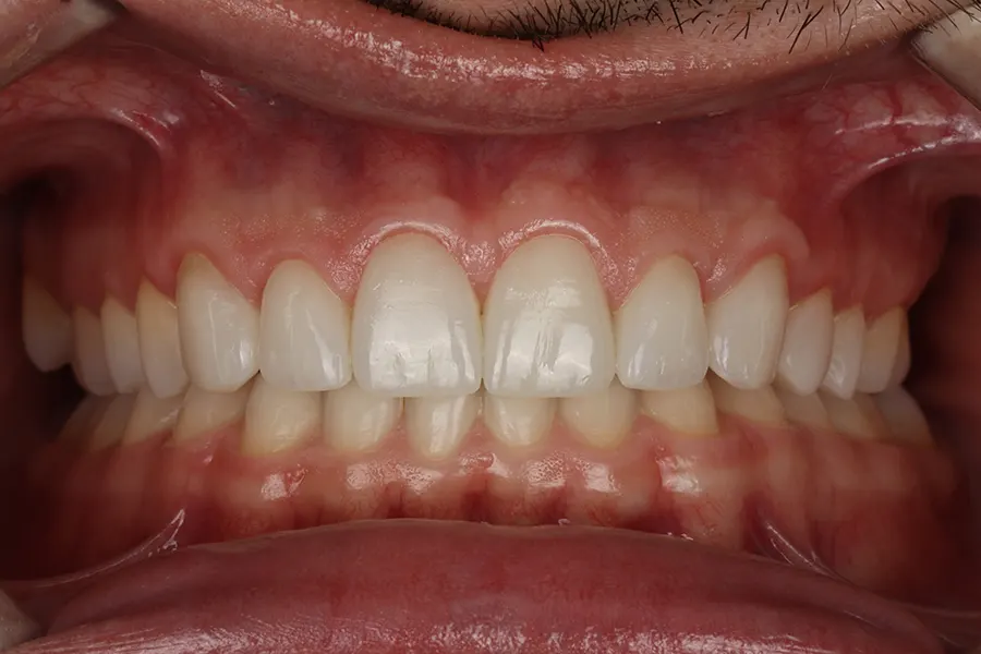 Caso Clínico de Carillas Dentales
