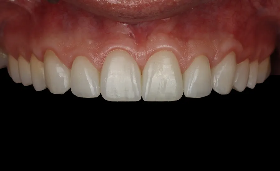 Caso Clínico de Carillas Dentales