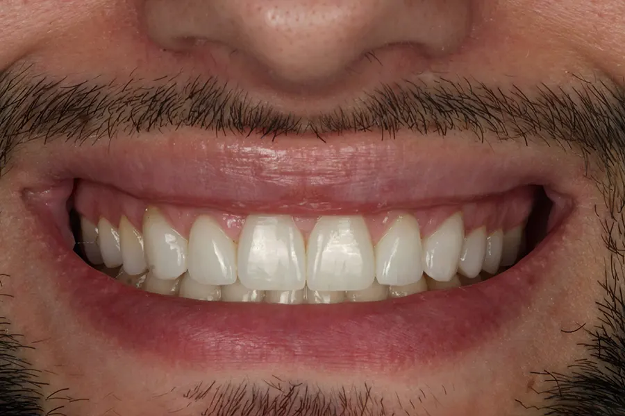 Caso Clínico de Carillas Dentales