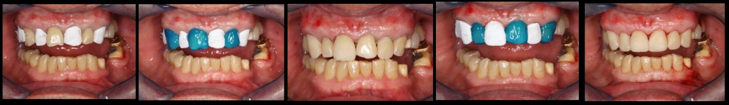 Caso composites inyectados