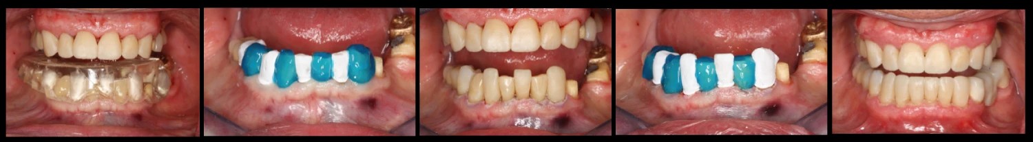 Caso composites inyectados