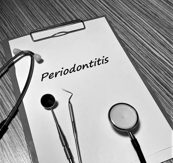 ¿En qué consiste una sesión de mantenimiento periodontal?