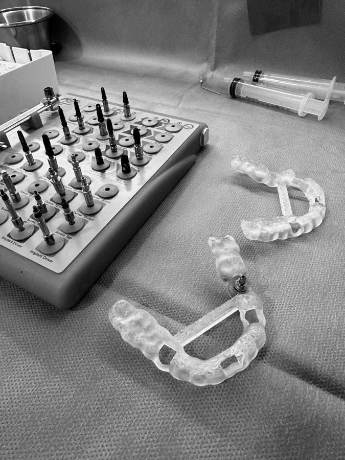 Beneficios de la cirugía guiada en los implantes dentales