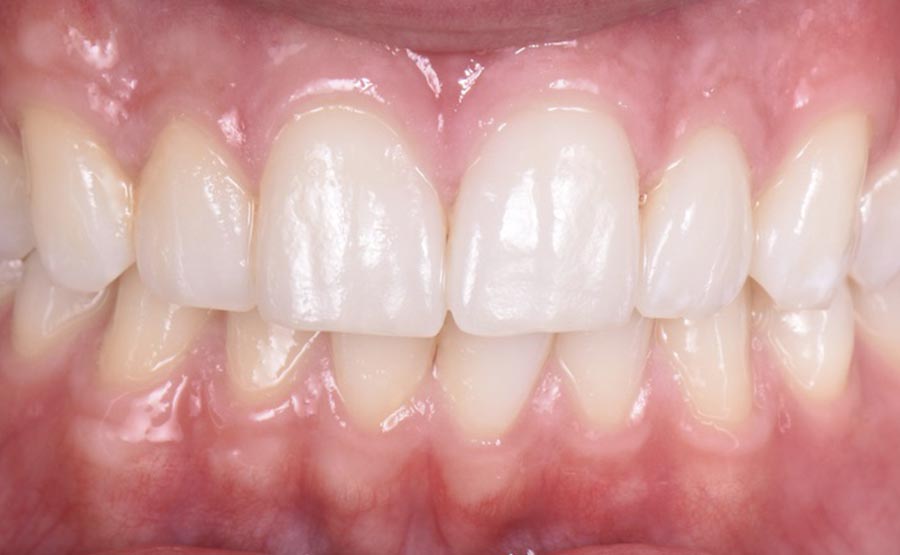 Recesiones gingivales caso clínico despues