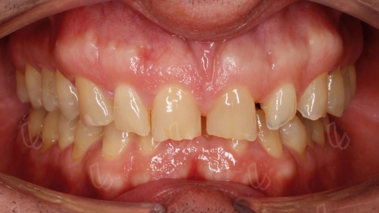 Compensaciones dentales