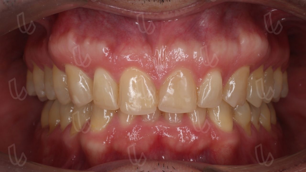 Compensaciones dentales