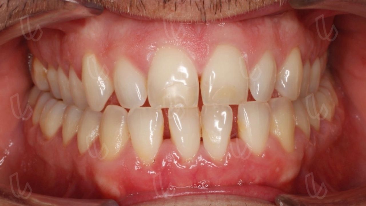 Compensaciones dentales