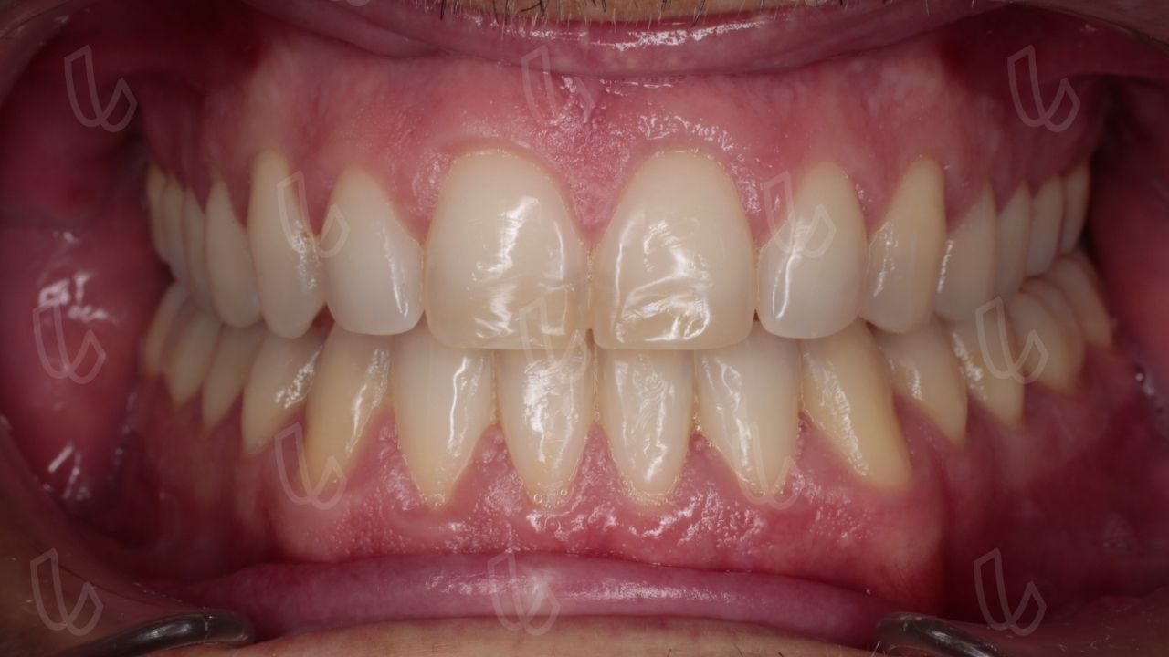 Compensaciones dentales
