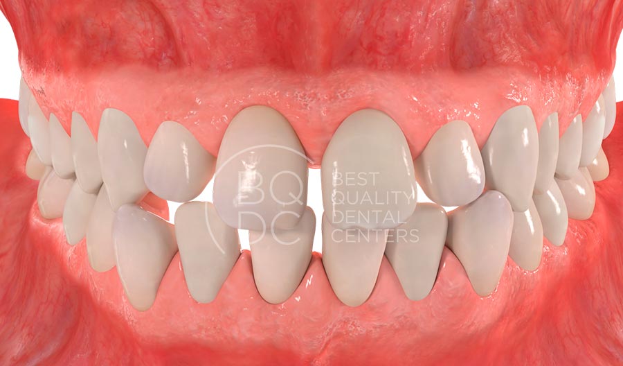 Diastema (sobra espacio)