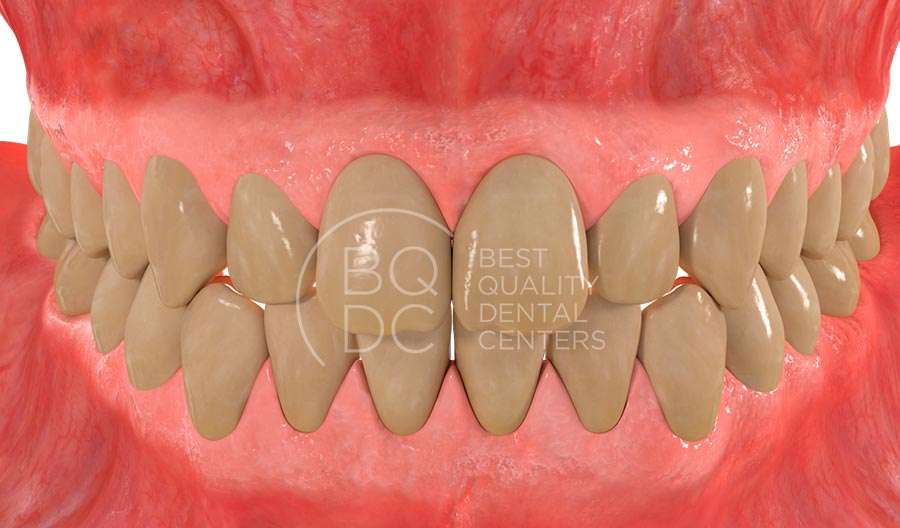 Dientes amarillos