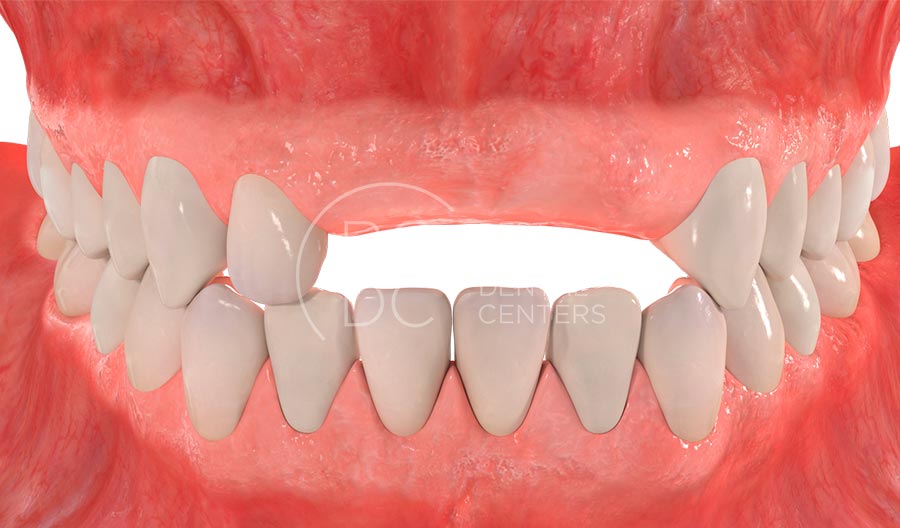 Ausencia de varios dientes