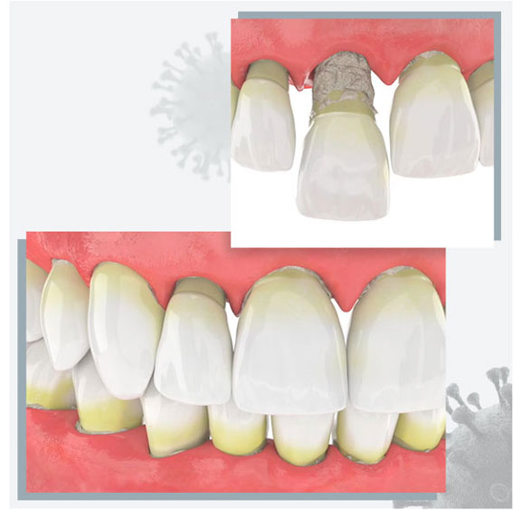 ¿Por qué la periodontitis empeora el pronóstico de COVID-19?
