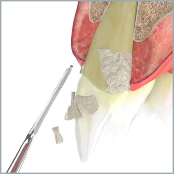 Cómo podemos prevenir la periodontitis