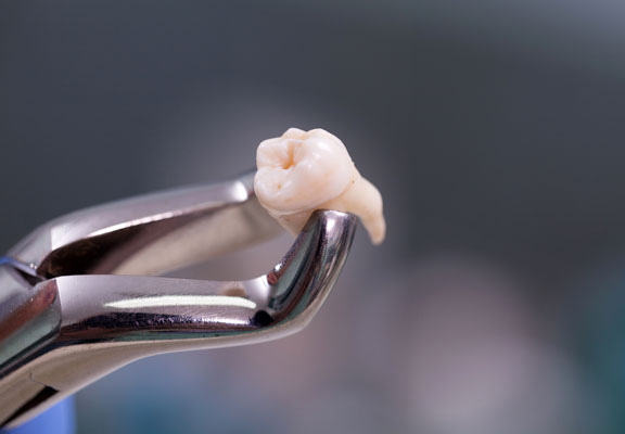 Si se necrosa la raíz de un diente se tiene que extraer para que no infecte al resto de piezas