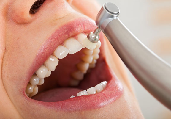 Las limpiezas dentales perjudican al esmalte