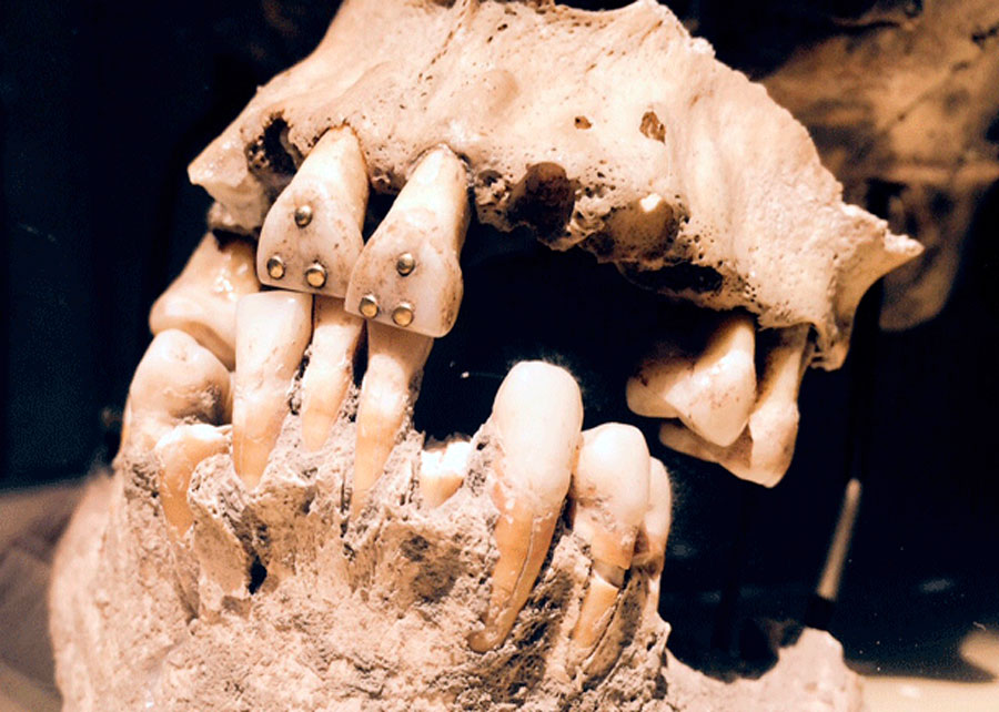 Origen y evolución de las joyas dentales